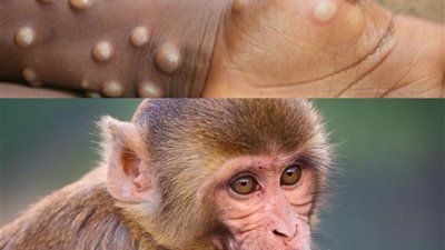 يجتاح 16 دولة أفريقية.. تطورات صادمة حول جدري القرود