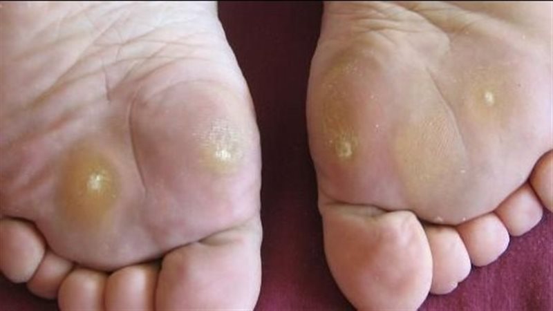 طرق لعلاج عين السمكة