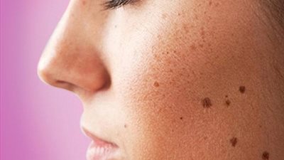 طريقة التخلص من بقع البشرة؟ إليك بعض النصائح المذهلة والسريعة 