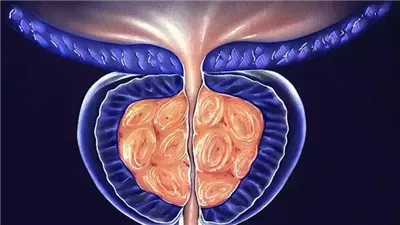 مشروبات فعّالة لعلاج تضخم البروستاتا.. ونصائح هامة للحفاظ على صحتك
