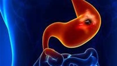 منها الشطة والطماطم.. احذر هذه الأطعمة التي تسبب قرحة المعدة