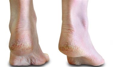 كيفية التخلص من الكعب المتشقق بطرق طبيعية ومضمونة مية في المية 