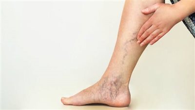 هل يساعد خل التفاح على علاج دوالي الساقيين ؟...اكتشف التفاصيل