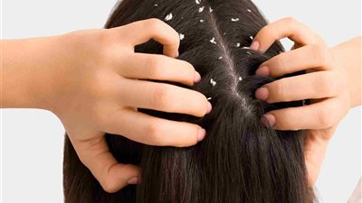 الجافة الأكثر شيوعًا.. أنواع قشرة الشعر وأسباب ظهورها في الرأس 