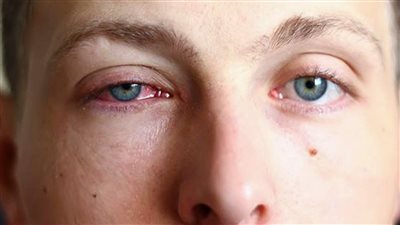 احذر من هذا المرض .. علاج فعال لانتفاخ العين المفاجئ 