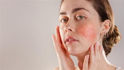 حلول سحرية لعلاج حبوب الوجه والحساسية بعد سن الثلاثين