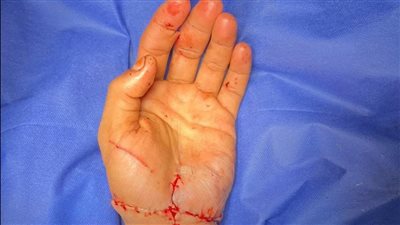 تفاصيل جراحة ناجحة لزرع يد مبتورة بالكامل بطب قصر العيني (صور)