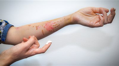 أعراض حروق الدرجة الأولى وأفضل الطرق المنزلية لعلاجها