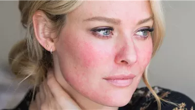 كيفية تقليل الإحمرار والإلتهاب الناتج عن حب الشباب