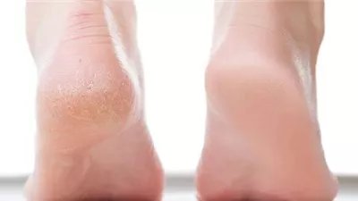 أسباب تشقق القدمين وأفضل العلاجات الطبيعية للتخلص منها