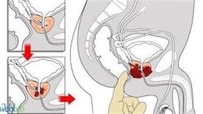 كل ما تحتاج معرفته عن سرطان البروستاتا .. دليلك للوقاية والعلاج