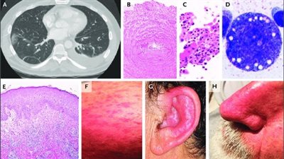 متلازمة VEXAS.. مرض مناعي خطير ونادر ظهر في مصر وإليك طرق الوقاية منه
