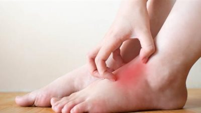 تخفيف تورم القدمين باستخدام الماء والملح.. خطوات فعالة