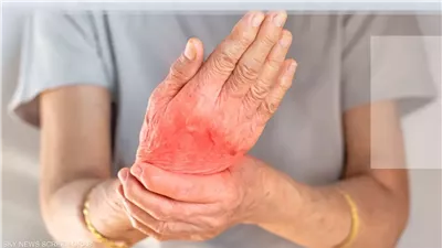 أسباب التهاب المفاصل الروماتويدي والأعراض وطرق العلاج .. تعرف على التفاصيل 