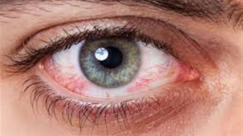 التهاب الملتحمة