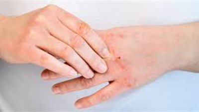 طرق فعّالة للتخلص من جفاف الجلد والحفاظ على ترطيب البشرة