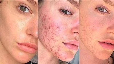 نصائح العناية بالبشرة لتقليل التهابات حب الشباب.. إليك التفاصيل