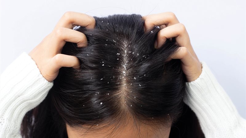 طرق التخلص من قشرة
