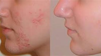 بشرة صافية بدون حبوب.. 5 وصفات طبيعية موجودة فى المنزل ممكن تجربيها 