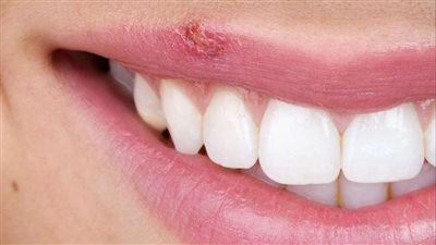 نصائح العناية اليومية أثناء الإصابة بالهربس الفموي.. اعرف طرق الوقاية والعلاج
