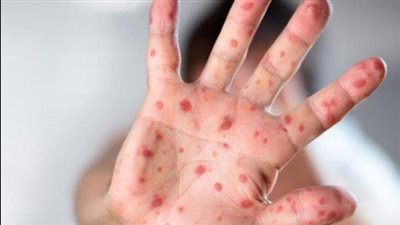 السلطات المغربية تؤكد أن نقص اللقاحات هو أحد أسباب تفشي مرض الحصبة