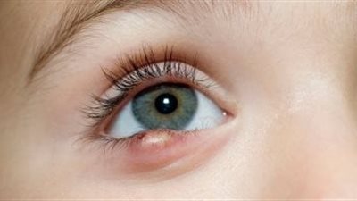 طرق فعالة لعلاج دمل شعيرة العين بسهولة في المنزل.. إليك التفاصيل 