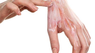 احذري من علاج الحروق بطريقة خاطئة.. إليك التفاصيل