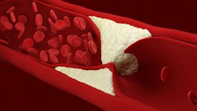 اكتشاف تأثير دواء مشهور لخفض الكوليسترول فى علاج كورونا