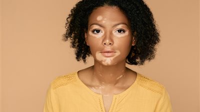 البهاق والصحة العقلية .. كيف تقلل من القلق والاكتئاب؟