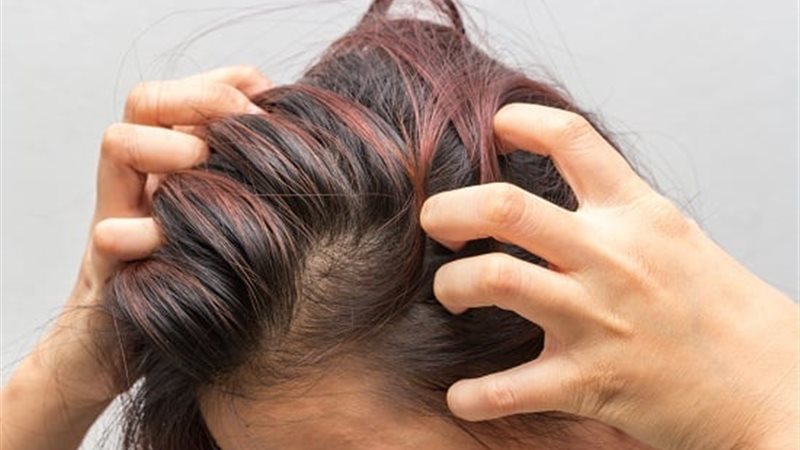 حكة فروة الرأس