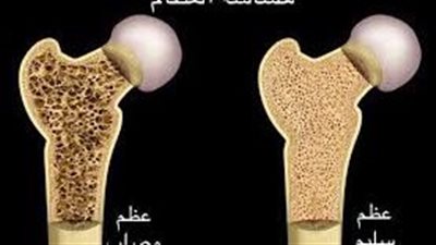علاج هشاشة العظام.. هيئة الدواء المصرية توصي بالكالسيوم والرياضة والأدوية المناسبة