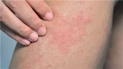 إحذر من هذا المرض.. تعرف على مرض متلازمة الجلد المحمص 