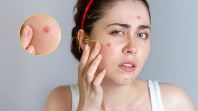 كيفية التخلص من حب الشباب بمكونات بسيطة من منزلك.. تفاصيل