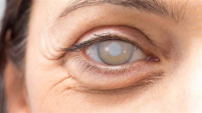 أسباب الإصابة بإعتام عدسة العين مع التقدم في العمر وطرق الوقاية