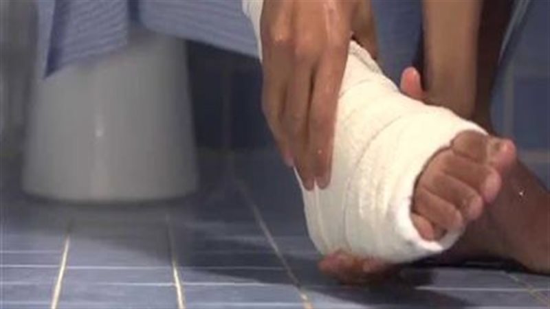 حكم المسح على الجبيرة