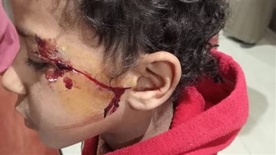 تفاصيل إصابة طفل بمدرسة مجمع شطورة في سوهاج بآلة حادة