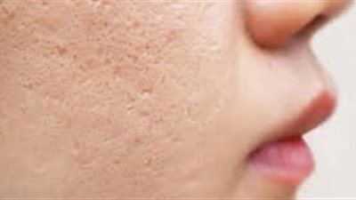 طرق إزالة وعلاج حفر الوجه طبيعيًا .. وصفات فعالة لبشرة صافية