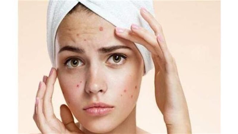طرق علاج حب الشباب