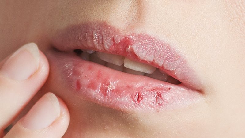 علاج تشقق الشفاه