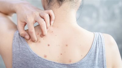 علاج حبوب الظهر بطرق طبيعية فعالة وآمنة دون آثار جانبية