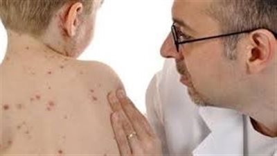 تسجيل أول وفاة بالحصبة في أمريكا منذ 2015 وتحذيرات من تفشي المرض