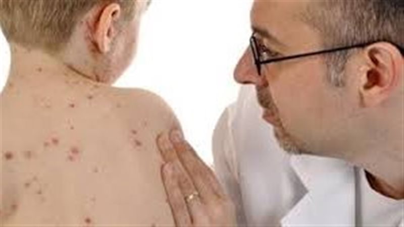 أعراض الحصبة وطرق
