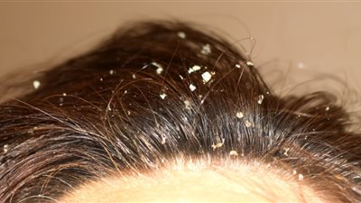 أفضل طرق علاج قشرة الشعر الدهني بوصفات طبيعية ومنزلية