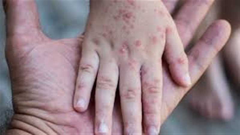 الجديري المائي بمدرسة