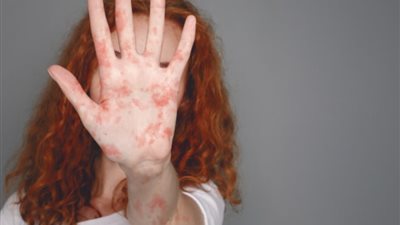 فيروس الحصبة يهدد الصحة العامة.. كيف تحمي نفسك من الإصابة؟