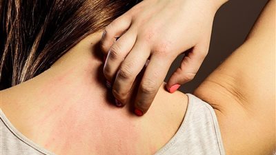 علاج حساسية الجلد بالأعشاب الطبيعية.. حلول فعالة لتهدئة البشرة