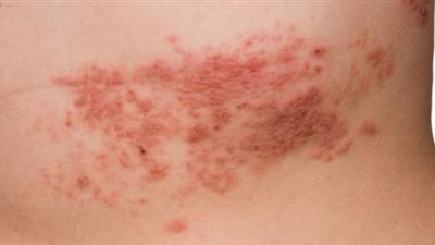 كيف ينتقل فيروس الهربس؟.. طرق العدوى وأهم وسائل الوقاية