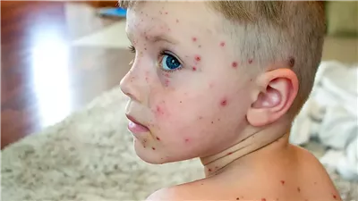 حقيقة تفشي الجدري المائي بالمدارس.. التعليم والصحة ترد