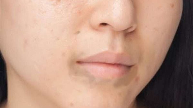 التخلص من اسمرار