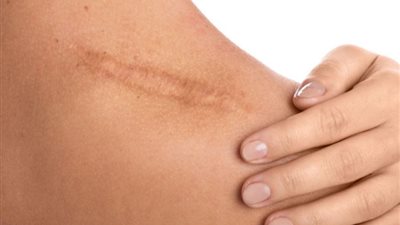 أفضل العلاجات المنزلية والطبية للتخلص من آثار الجروح نهائيًا